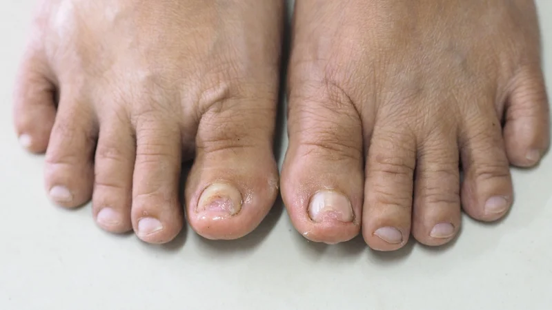 Avoid toenail infection