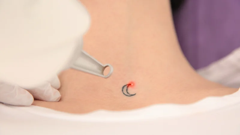 Laser tattoo removal