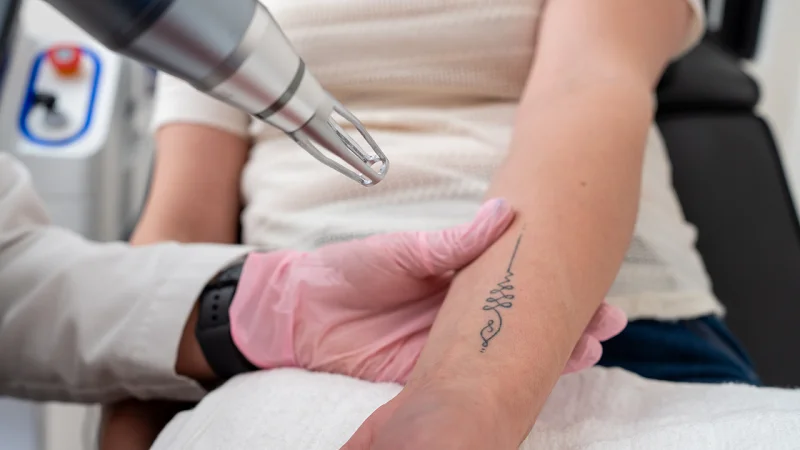 Laser treatment for tattoo removal
