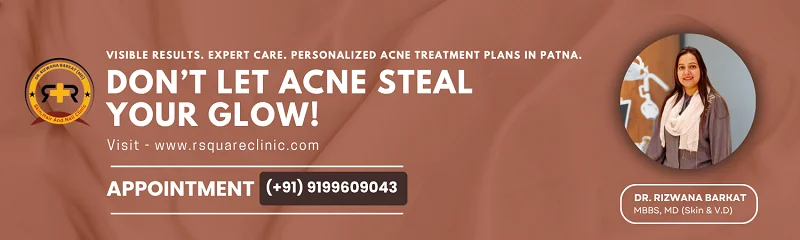 acne scar treatment in Patna