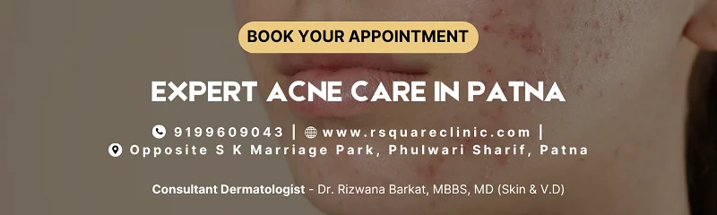 acne treatment in Patna