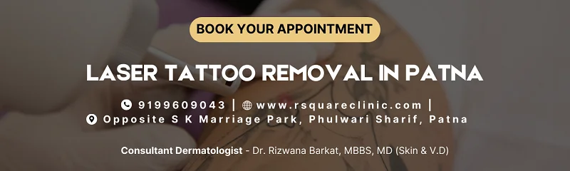 laser tattoo removal clinic Patna