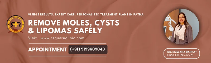 mole removal in Patna Dr. Rizwana Barkat