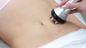 stretch mark care