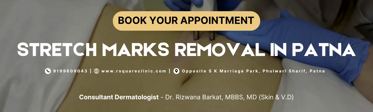 Stretch Marks Treatment in Patna