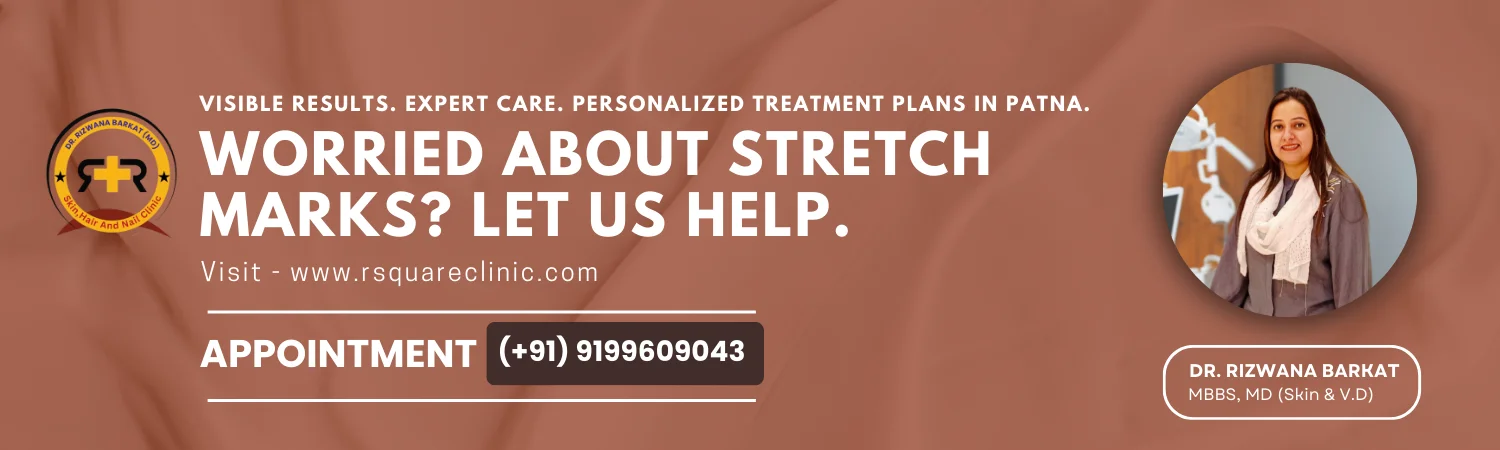 stretch mark removal in patna
