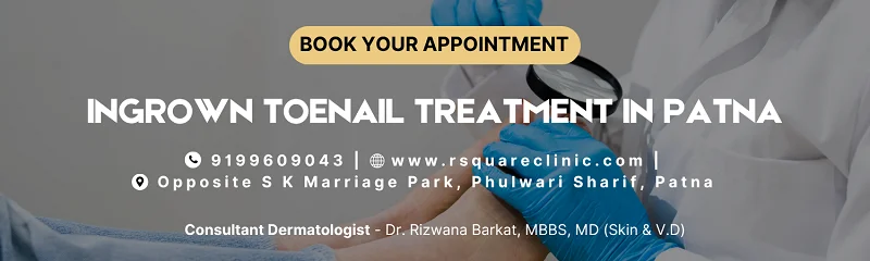 Ingrown toenail medical treatment Patna