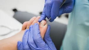 Ingrown toenail surgery