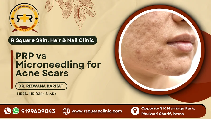 PRP vs microneedling for acne scars