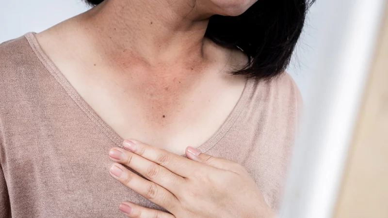 Sun exposure effects on moles