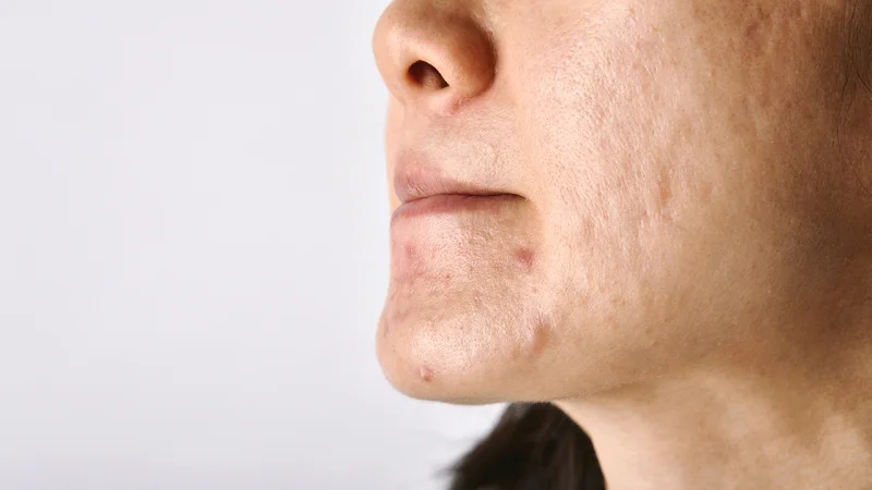 does microneedling with prp help acne