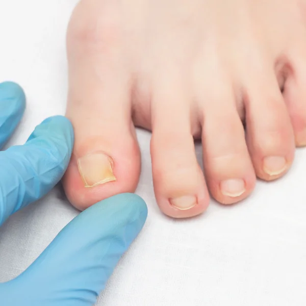 ingrown toenail treatment in patna