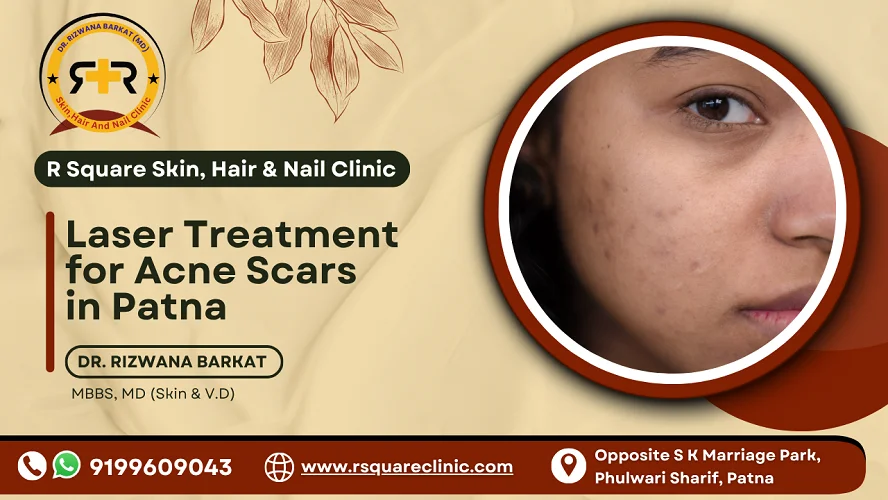 laser treatment for acne scars in patna