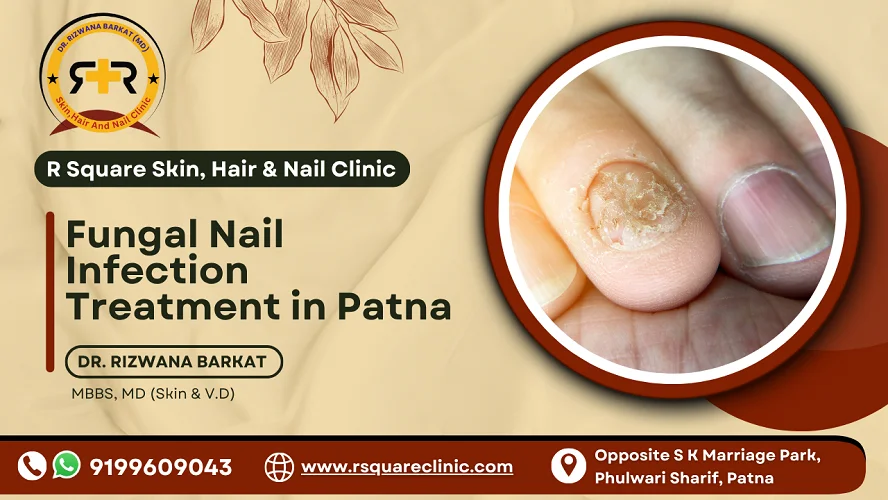 Fungal Nail Infection Treatment in Patna