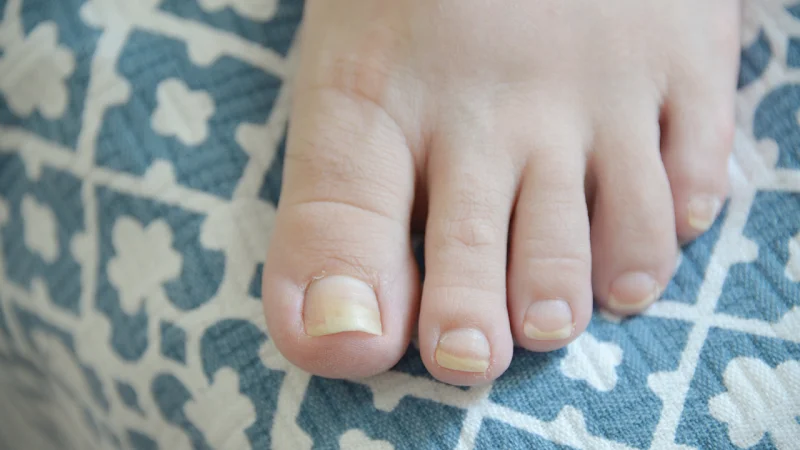 Nail infection treatment