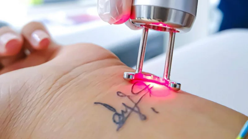 Cost of Q-Switched Laser Treatment