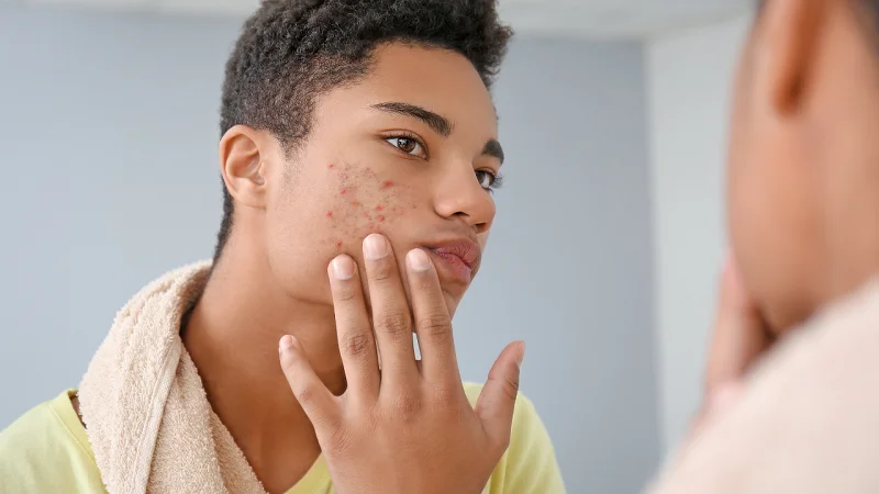 pimples in teenager