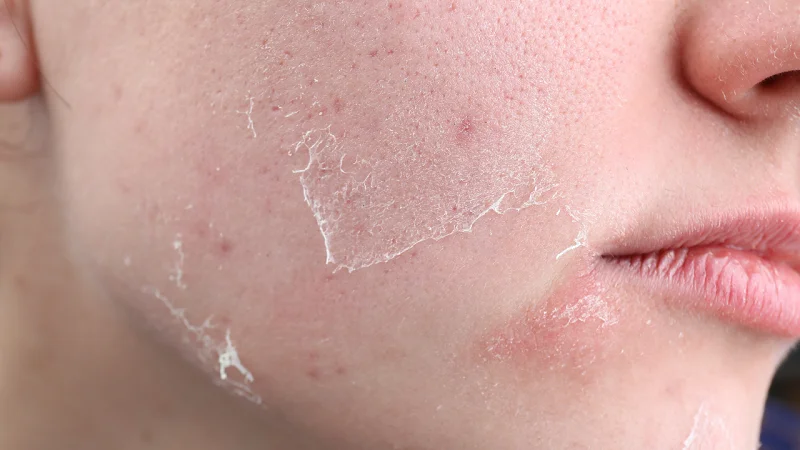 damaged skin barrier