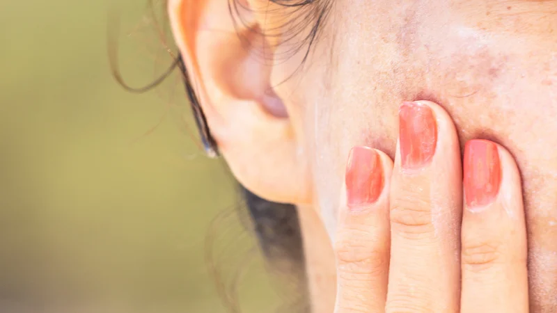 Hyperpigmentation in winter