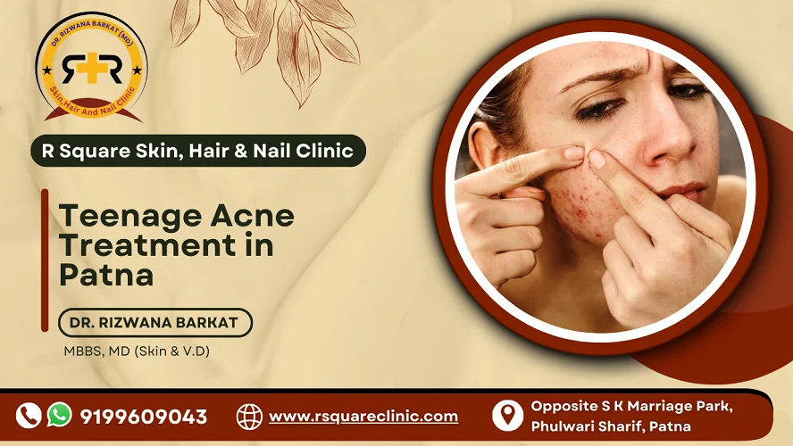 Teenage Acne Treatment in Patna