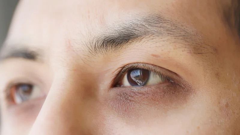 dark circle treatment