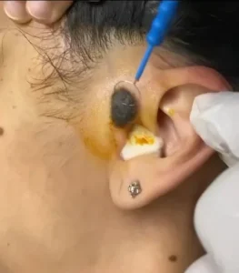 Mole removal at R Square Clinic in Patna