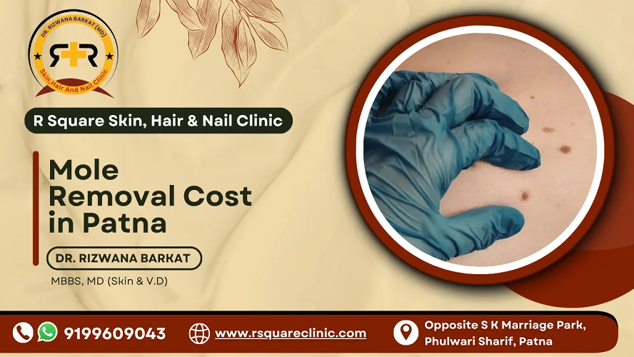 Mole removal cost in Patna