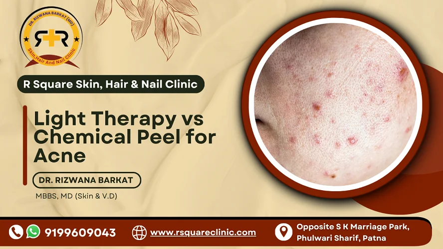 light therapy vs chemical peel for acne