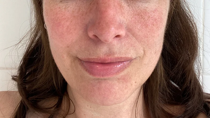 melasma pigmentation on face