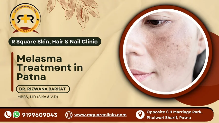 Melasma Treatment in Patna