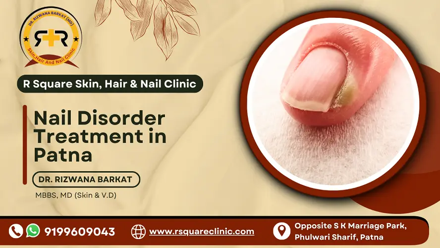 Nail Disorder Treatment in Patna