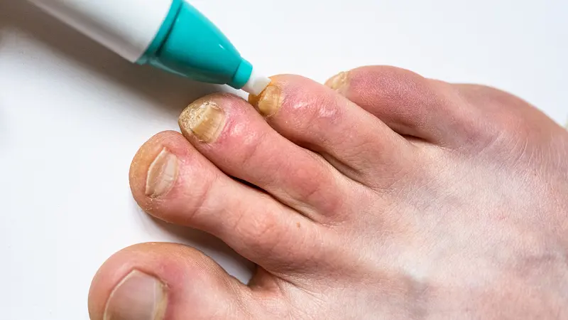 Nail disease treatment