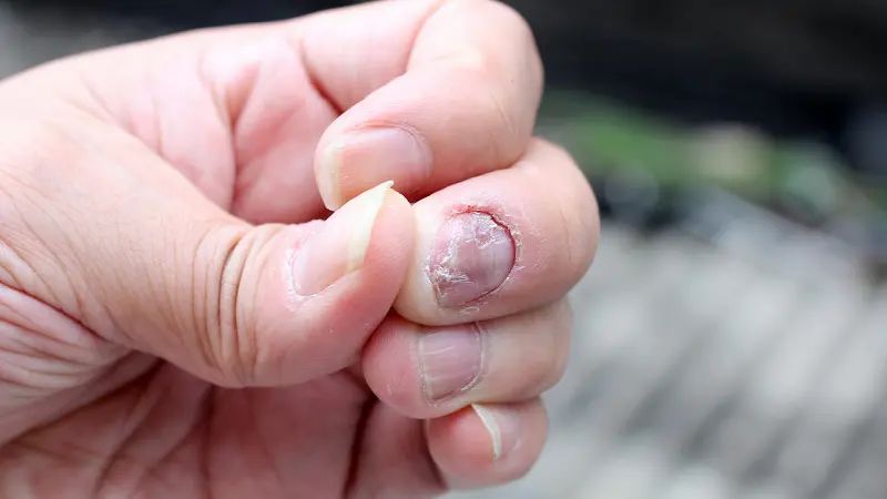 Onychomycosis