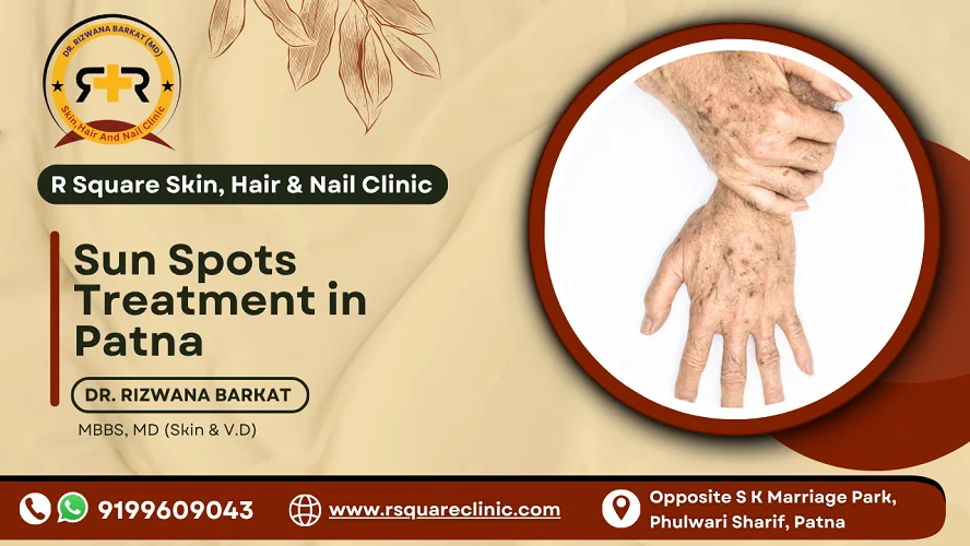 Sun Spots Treatment in Patna