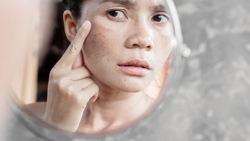 melasma on face