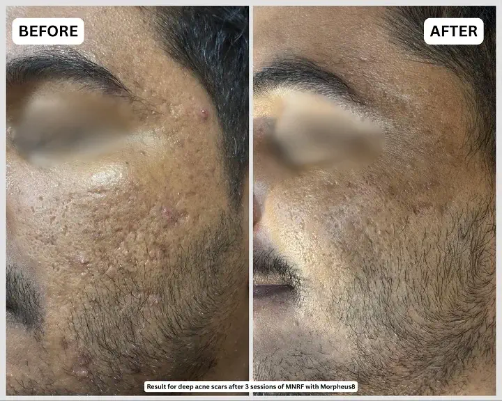 Deep acne scars before and after results