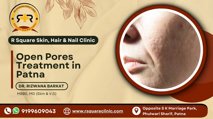 Open Pores Treatment in Patna