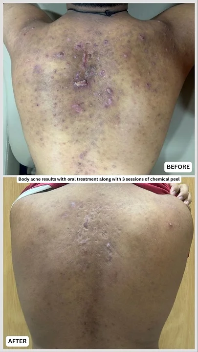 body acne before and after