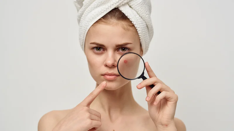 chemical peeling for acne