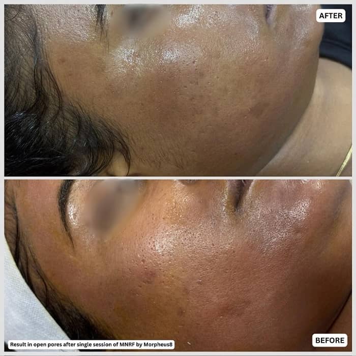 open pores before after results