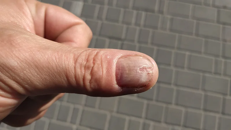 Nail Fungus