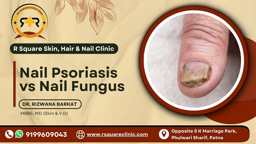 Nail Psoriasis vs Nail Fungus