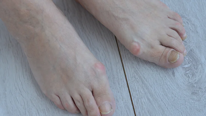 Nail Psoriasis