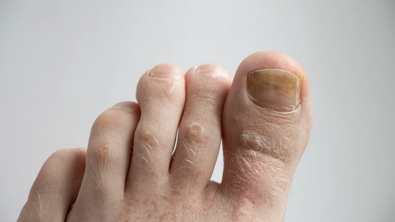 nail disease