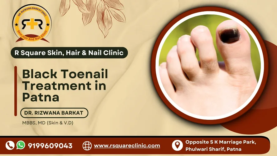 Black Toenail Treatment in Patna
