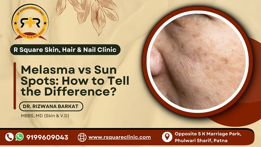 Melasma vs Sun Spots