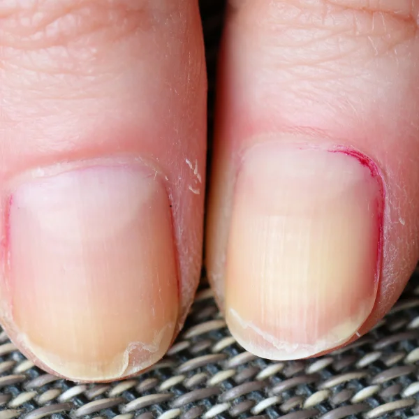 peeling nail treatment in patna