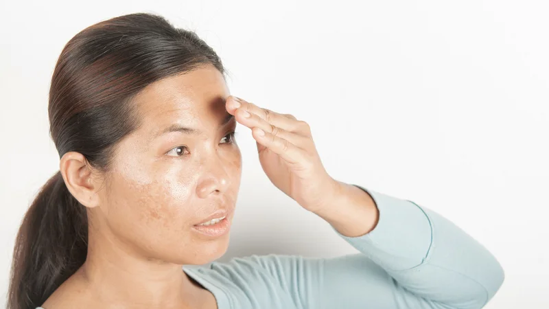 sun spots on face