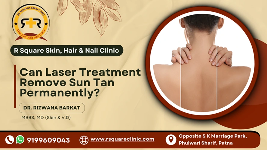 Can Laser Treatment Remove Sun Tan Permanently?