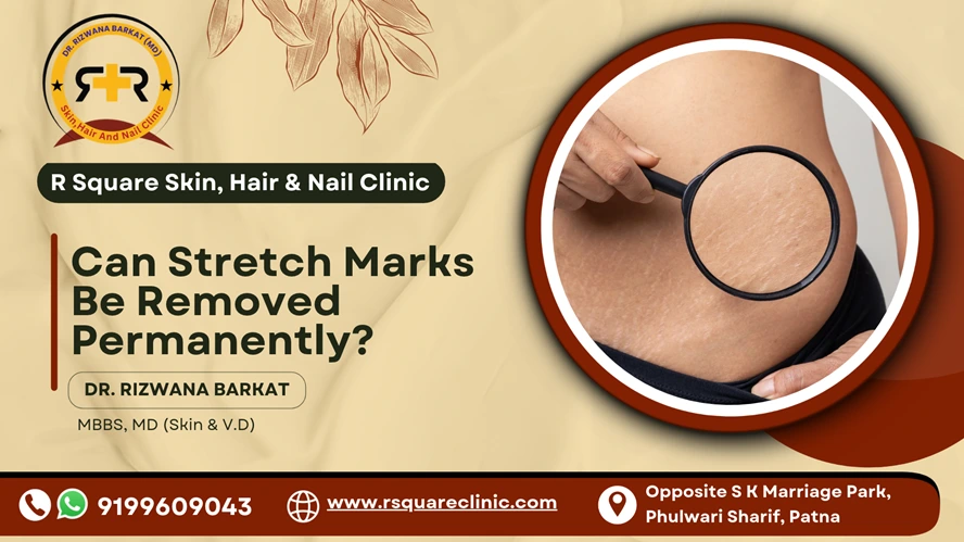 Can Stretch Marks Be Removed Permanently?